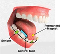 Internal Tongue Drive System (iTDS) consists of a permanent magnet attached to the tongue, plus an array of magnetic sensors around the lower teeth on a dental retainer.