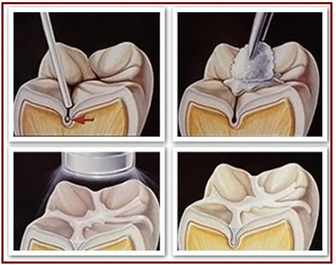 The procedure for dental sealants costs one-third of the price of filling a cavity.https://www.vistadental.com/preventative/dental-sealants/