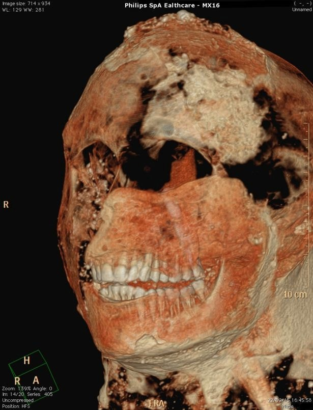 Pompeii-scans-Romans-good-teeth