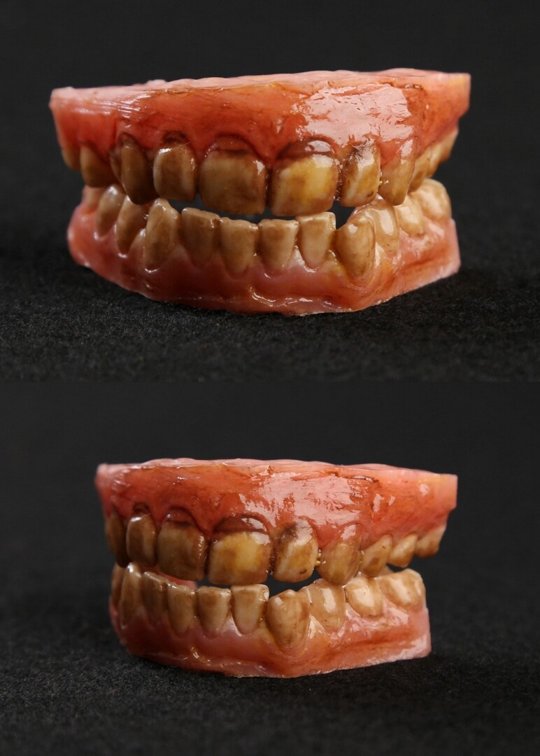 Two models of discolored teeth.