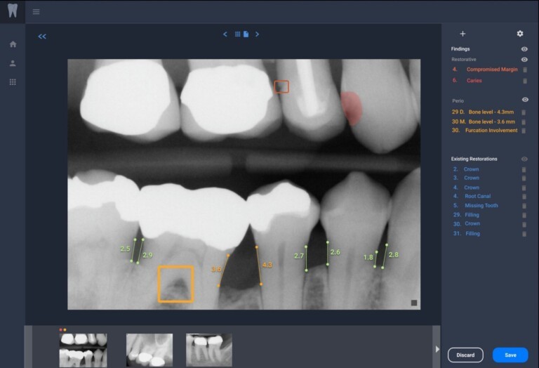 Overjet’s Clinical Intelligence Platform displays a radiograph with dental artificial intelligence findings