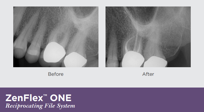 A before and after x-ray image of a row of teeth with two teeth highlighted as an area of focus.