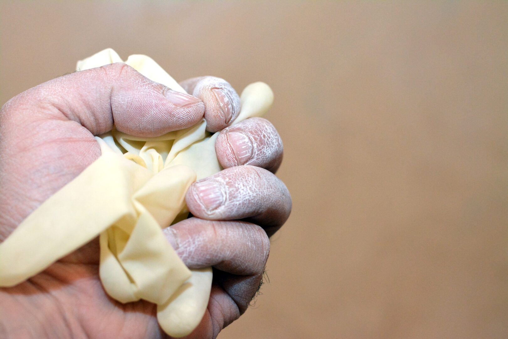An image of a dry and chapped hand holding a disposable glove in a fist.